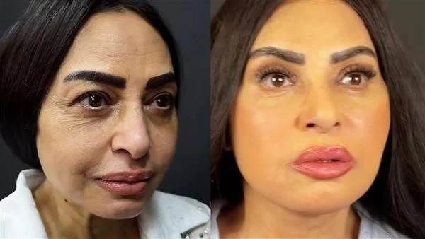 سلوى خطاب تكشف تفاصيل إجرائها لعملية تجميل بالوجه والرقبة فاجأت الفنانة سلوى خطاب الجمهور في أحدث ظهور لها بعد خضوعها لإجراء تجميلي في الوجه والرقبة كاشفة عن تفاصيل ا إقرأ المزيد